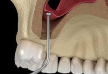 جراحی سینوس لیفت در تهران