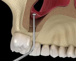 جراحی سینوس لیفت در تهران